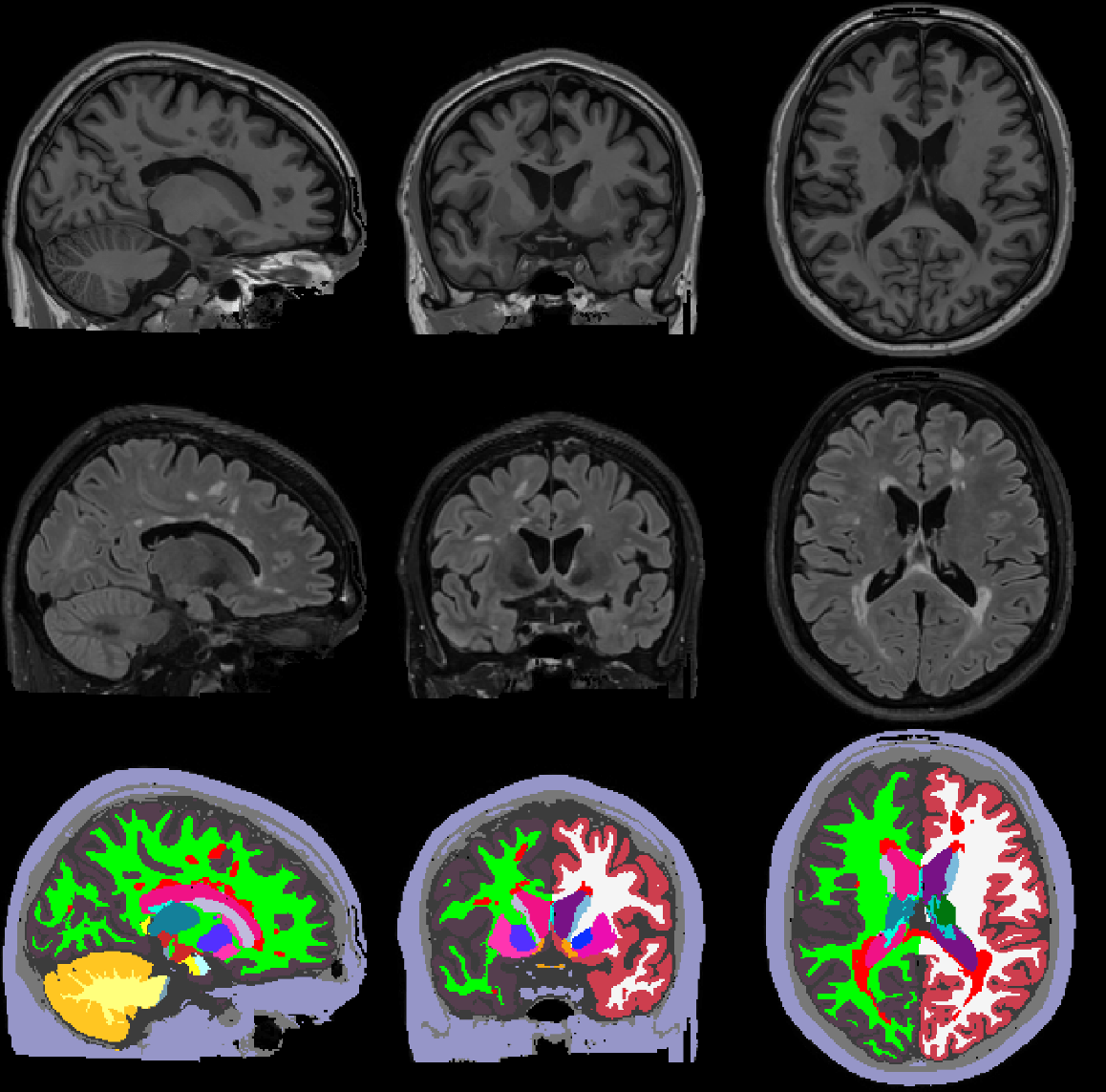 3D brain segmentation