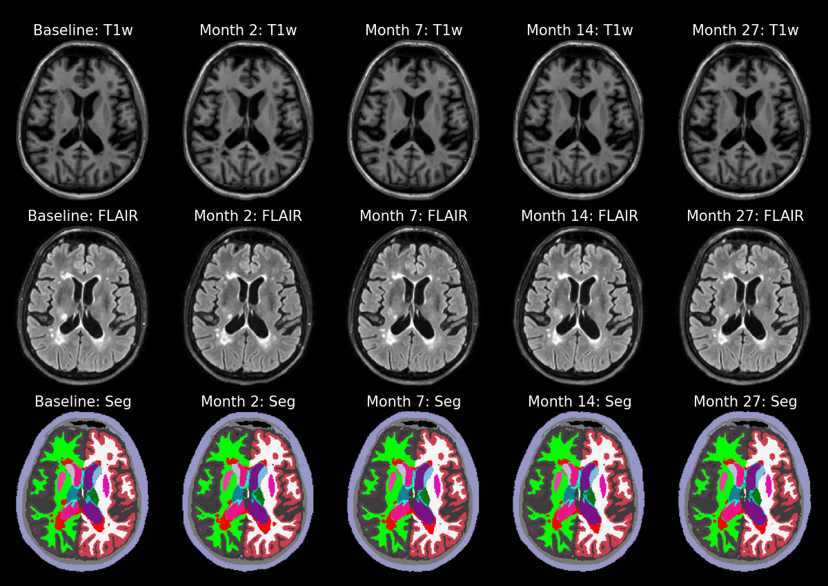 Longitudinal segmentation example