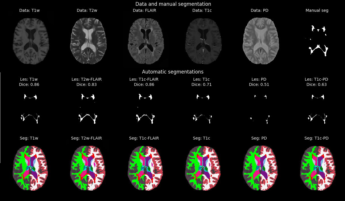SAMSEG lesion segmentation